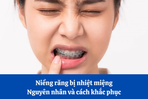 Niềng răng bị nhiệt miệng: Nguyên nhân và cách khắc phục